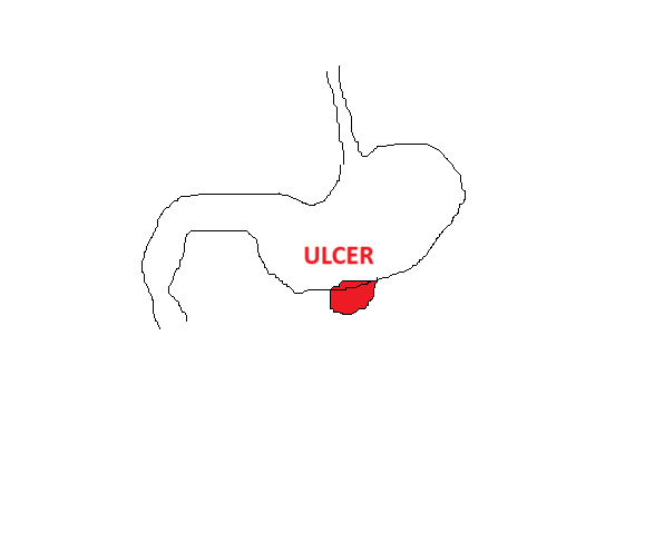 PEPTIC ULCER